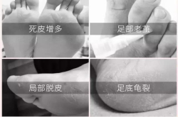 细节决定成败 脚皮不除就变老茧 教你一招祛除