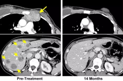 乳腺癌治疗新突破：实验性免疫疗法已经治愈了乳腺癌晚期患者