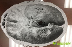 加拿大首例 利用3D打印脑部模型辅助切除肿瘤