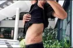 8年前那个为了买苹果手机而卖肾的小伙 现在过得怎么样了？
