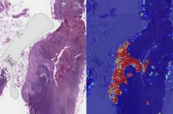 谷歌AI医疗新成果：将转移性乳腺癌检测准确率推向了几乎完美的99％